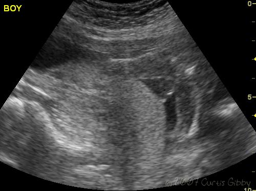 Pregnant Sarah - Ultrasound - It's a boy! (second child)